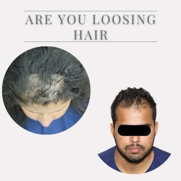 are you loosing hair